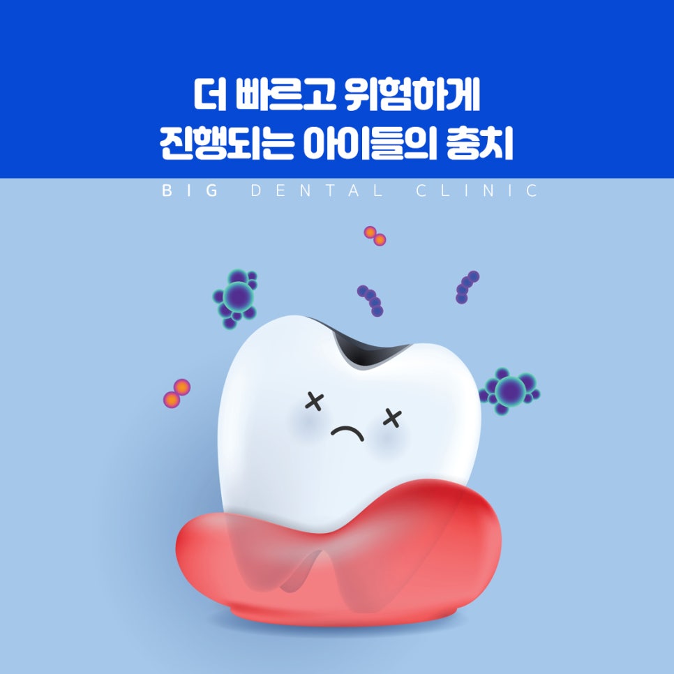 울산북구치과 상아질 치수까지 진행된 충치의 신경치료 발치 위험과 주의사항