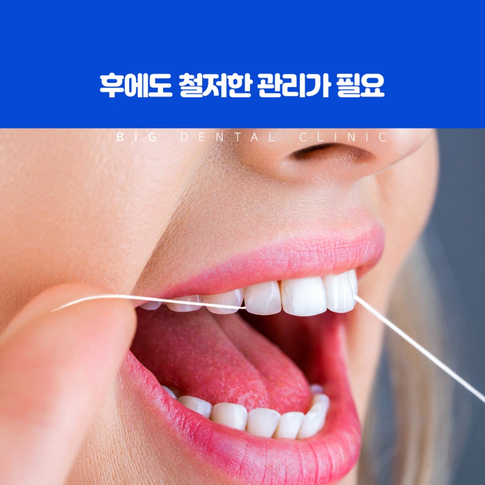 울산북구치과 겉은 멀쩡해도 속에서 진행되는 무증상 충치 갑작스러운 시림 증상