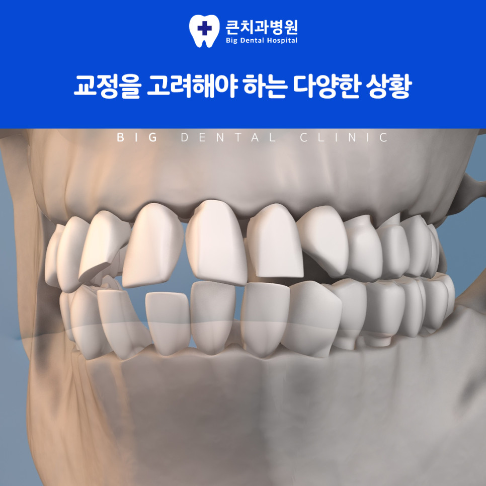 울산북구치과에서 연령과 생활 방식에 맞춘 다양한 교정 방법 선택 기준 정리