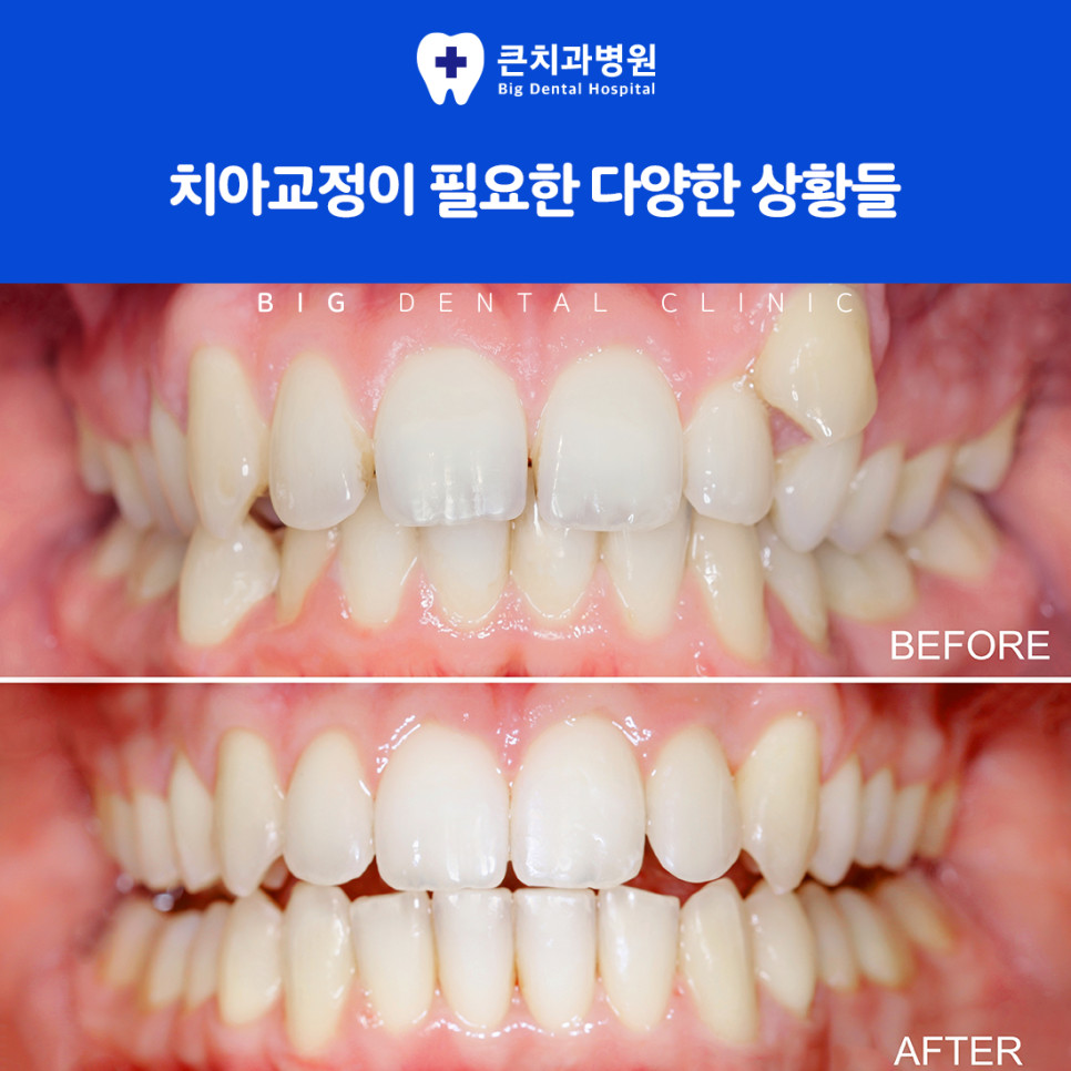 울산북구치과 치아 배열 유전 습관 외부 자극 원인과 교정 상담 전 확인 필요성