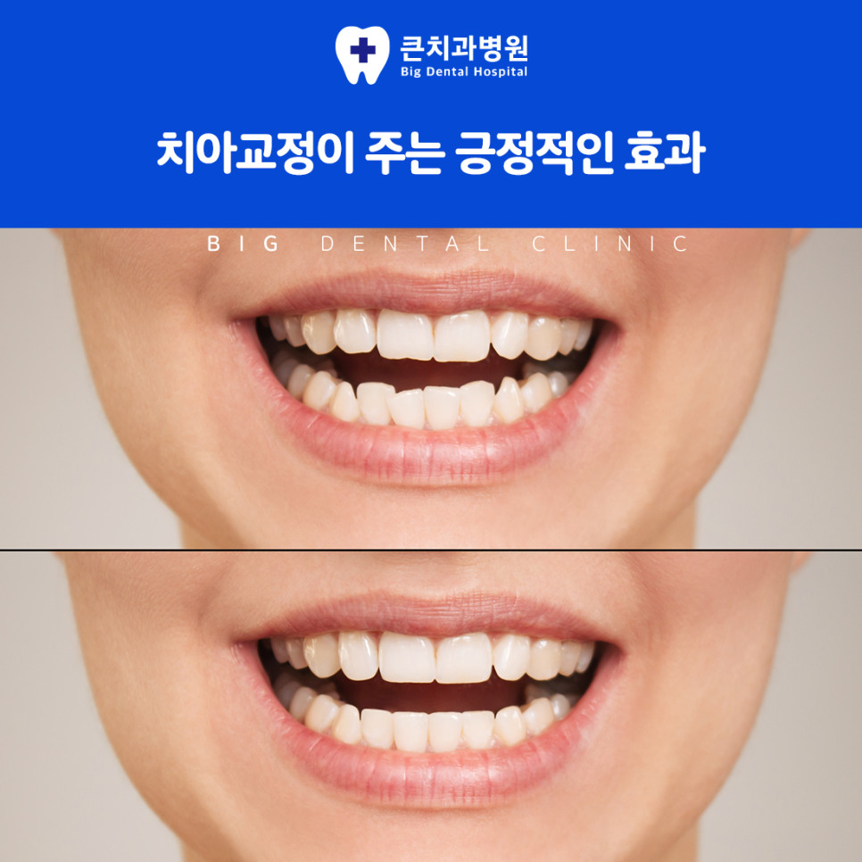 울산북구치과 맞춤형 치아교정 치료와 장기 관리 방법 기준이 필요한 이유 정리