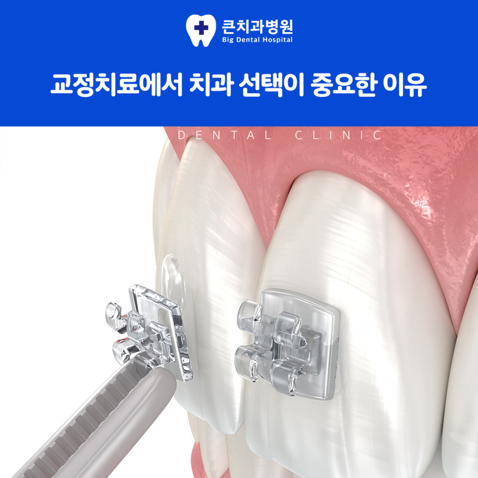 울산북구치과 치아교정으로 치열과 교합을 조화롭게 맞추는 치료 기본 개념 정리