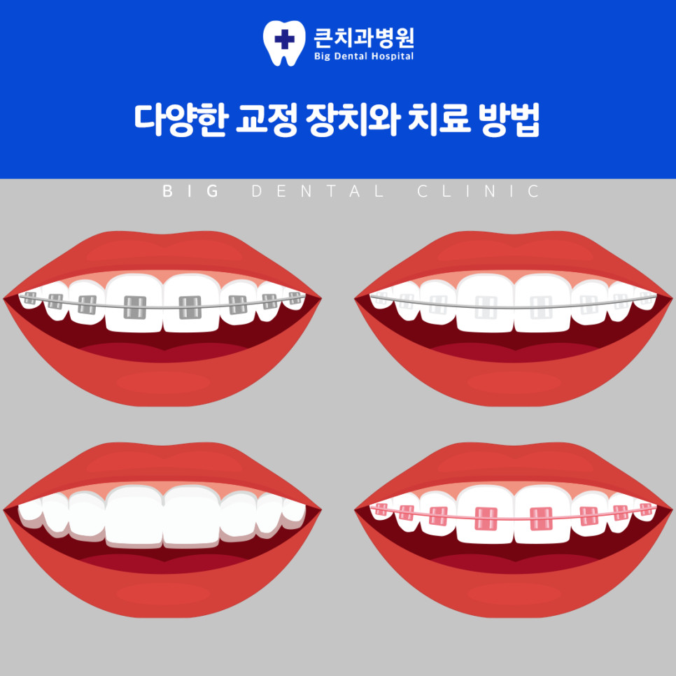 울산북구치과 위아래 교합 불균형으로 씹기 발음 소화 부담 주의사항 확인 방법