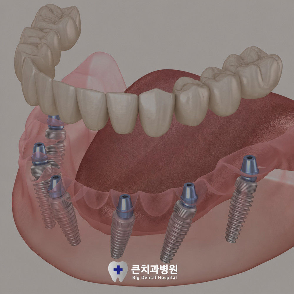 울산북구전악임플란트 전 치아 상실 식사 불편과 메뉴 선택 고민 주요 원인
