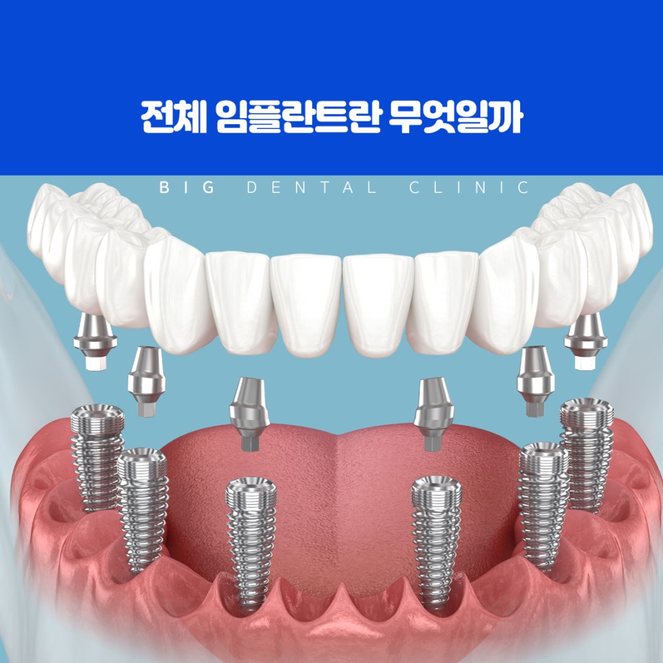 울산북구전악임플란트 선택 전 식사 기능 회복 치료 필요 시기와 확인 사항