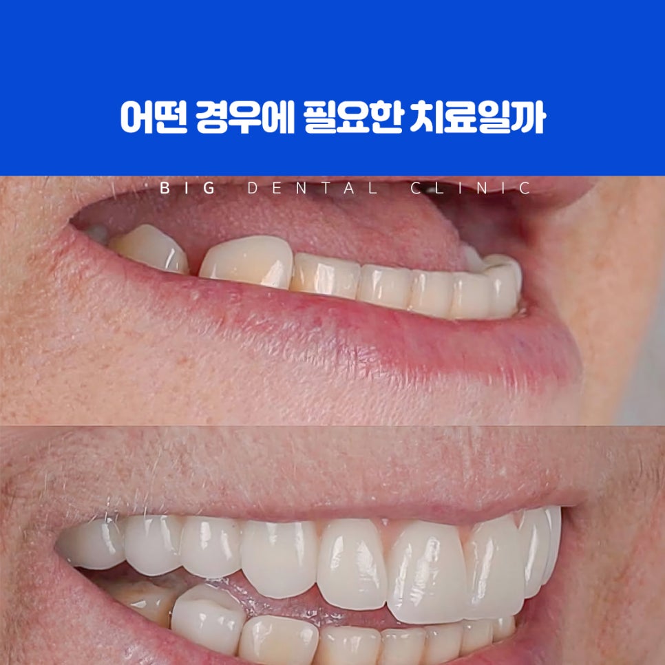울산북구전악임플란트 의미와 턱 전체 기준 기능 회복 방법 단계별 치료 개념