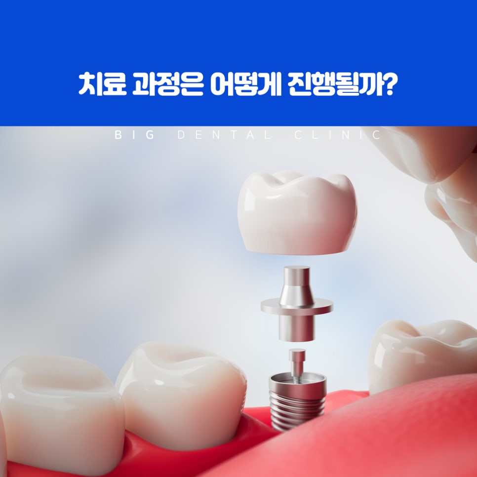 울산북구전악임플란트 계획에서 잇몸 턱뼈 남은 치아 확인 방법 종합 정밀 진단