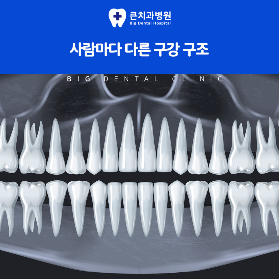다양한 임플란트 종류를 알아보는 환자