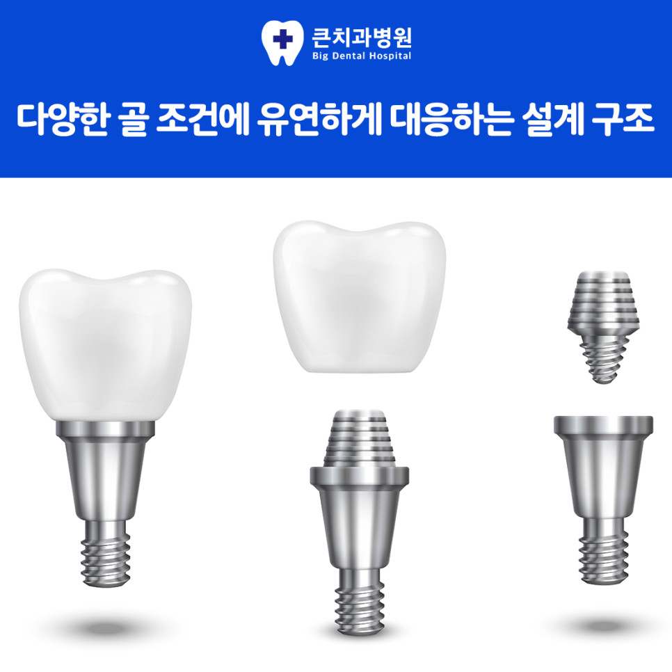 임플란트 식립 전 뼈 이식 필요 여부를 살피는 과정