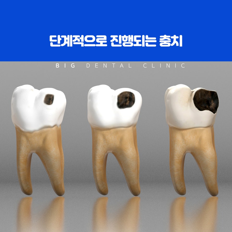 법랑질에서 시작된 충치를 확인하는 단계