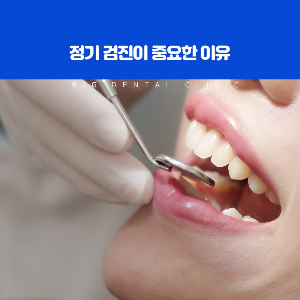 치아 사이의 색 변화로 찾는 작은 충치