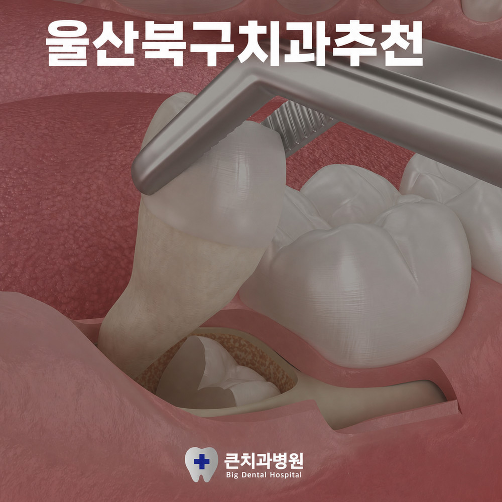사랑니 발치 전 울산북구치과추천 상담에서 확인하는 주의사항