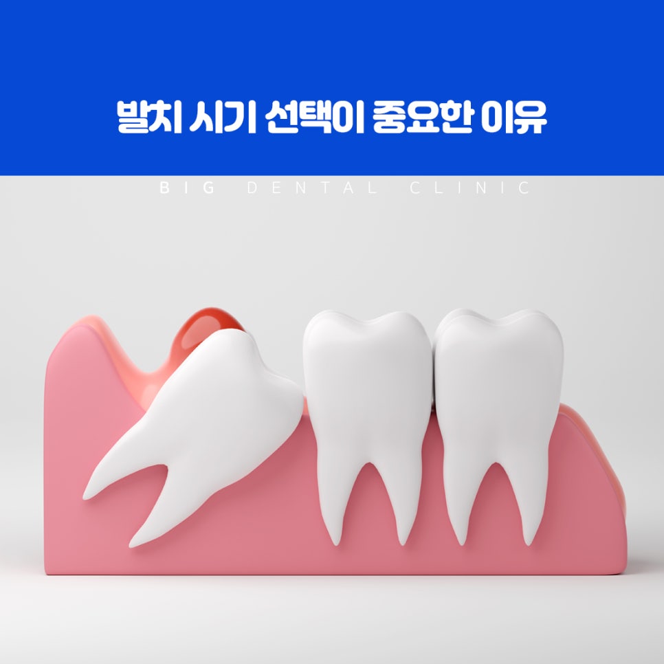 구강의 가장 안쪽에서 마지막으로 맹출하는 사랑니의 위치