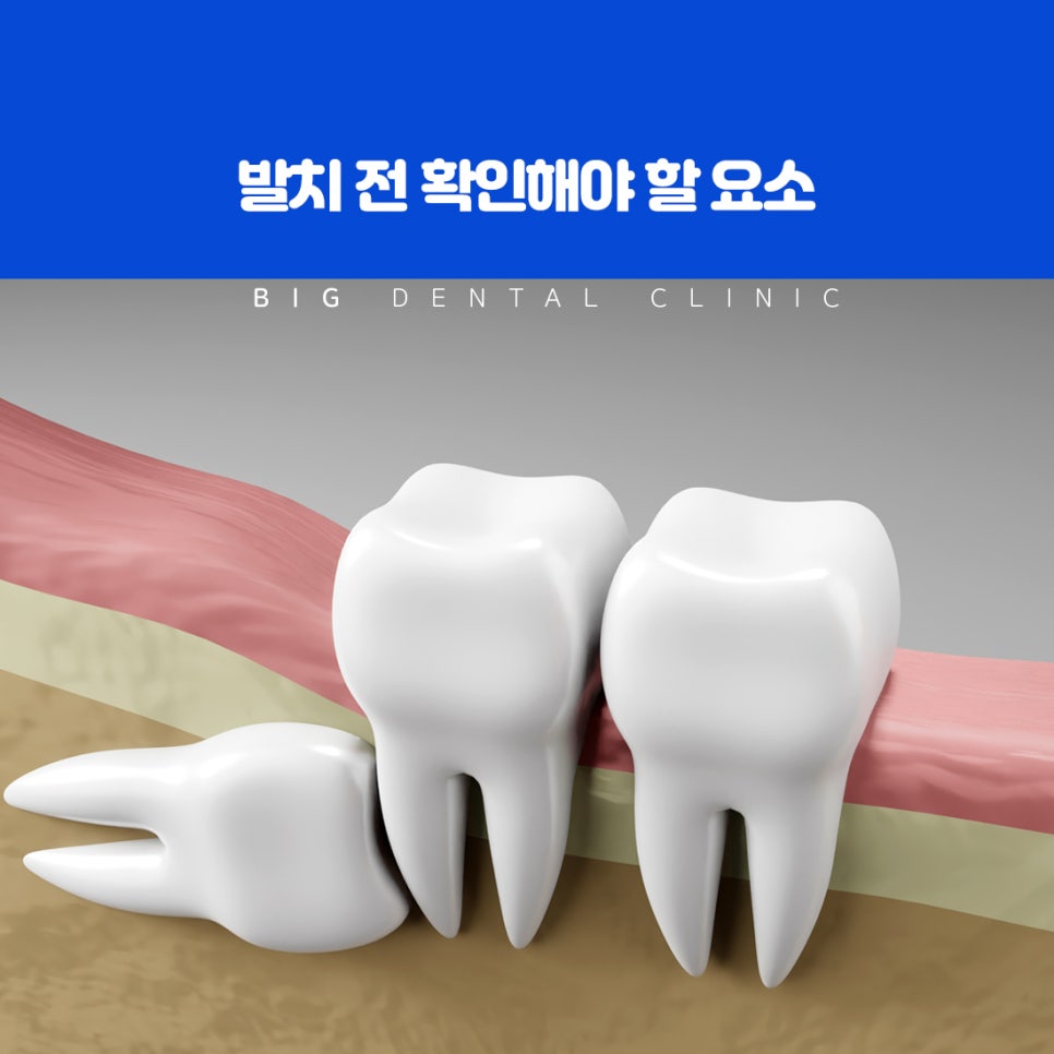 턱 공간이 부족해 기울어진 방향으로 맹출한 사랑니