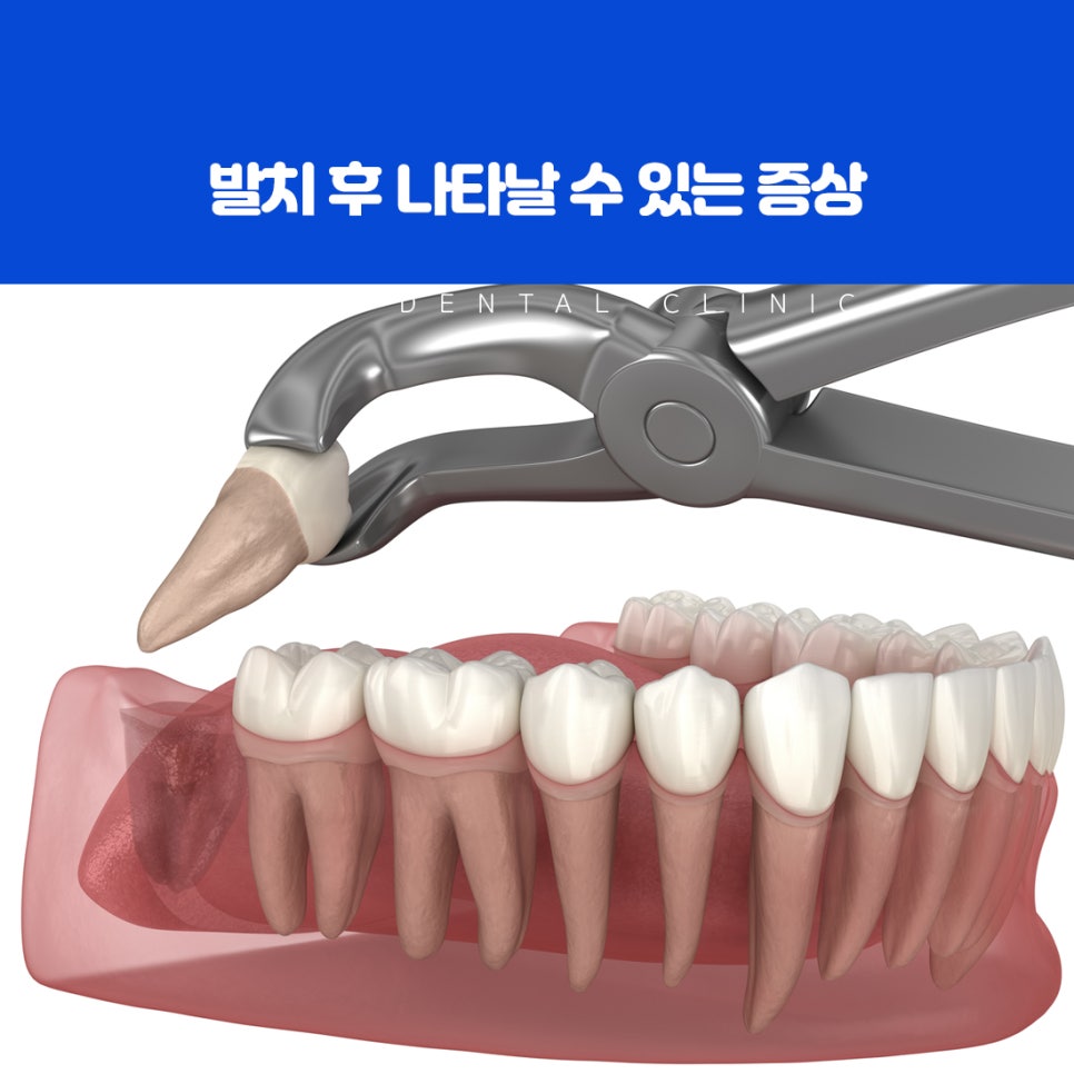 사랑니 주변 세균 번식으로 붓는 잇몸과 앞 어금니