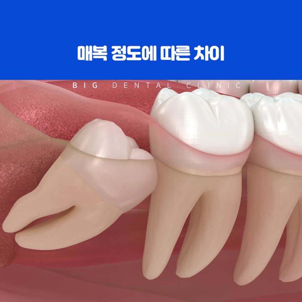 염증이 심해지기 전 계획하는 사랑니 발치 시기