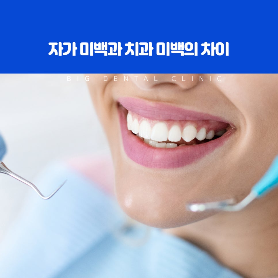 커피와 와인 등 색소가 강한 음식으로 생긴 치아 착색