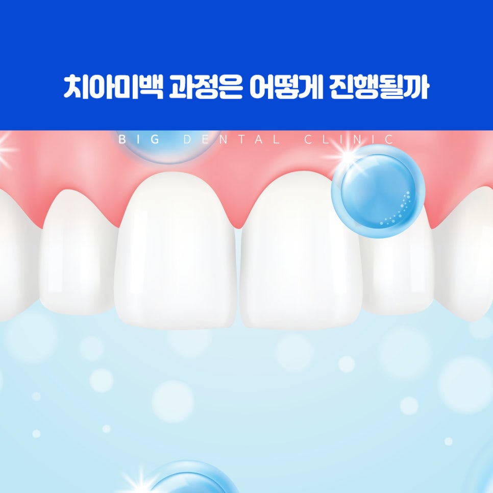 흡연과 노화로 점차 짙어진 치아 표면의 변색
