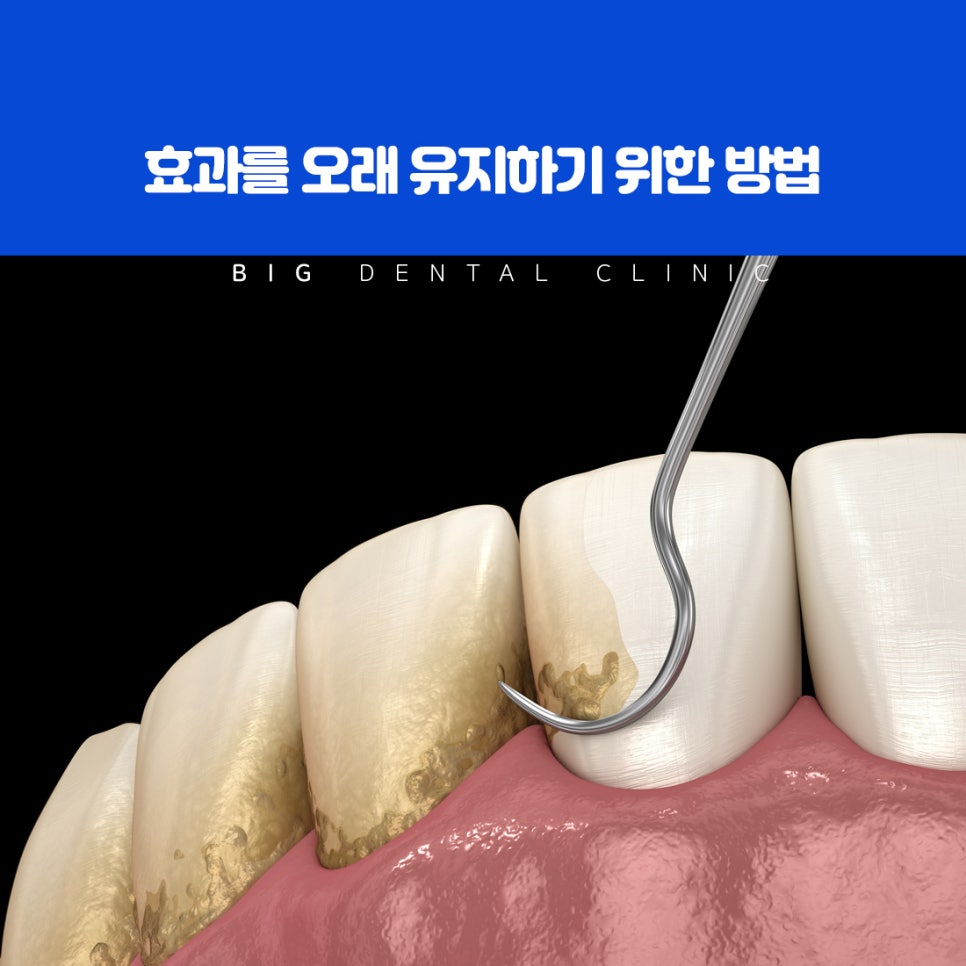집에서 쓰는 자가 미백 제품과 치과 미백의 차이