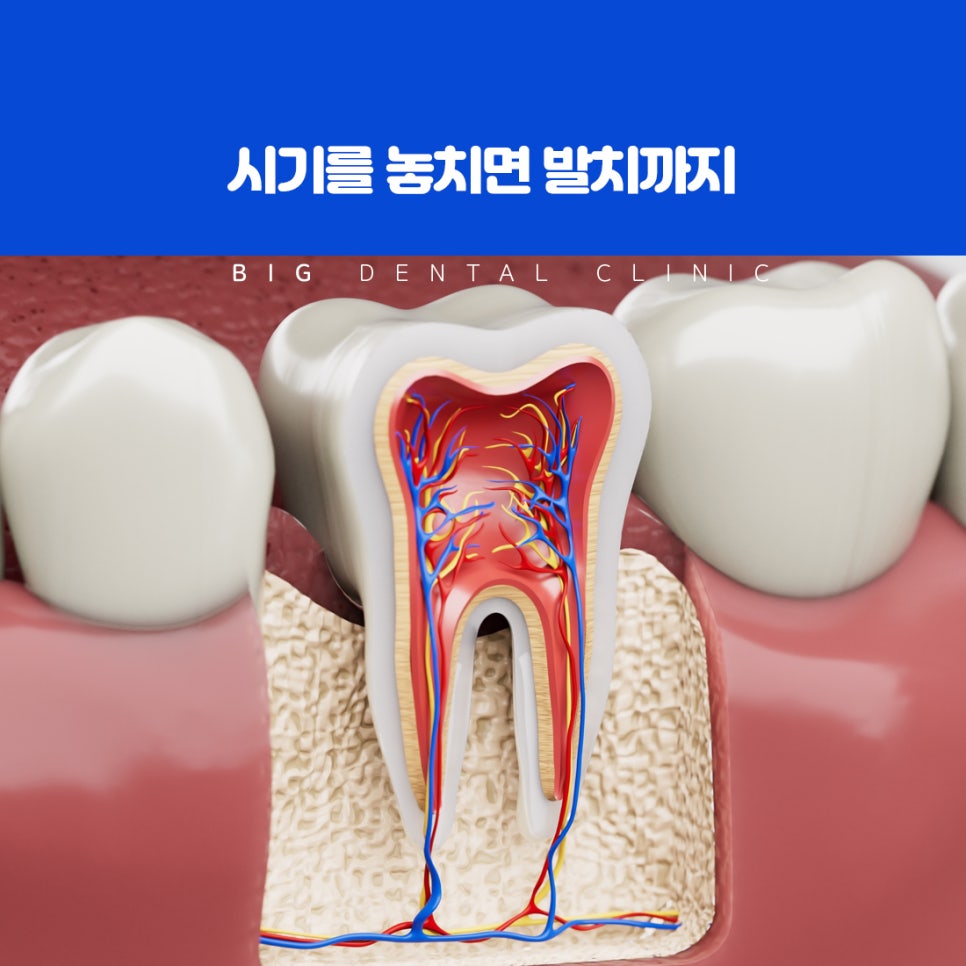 감염된 치수 조직의 신경과 혈관을 제거하고 세정하는 신경치료
