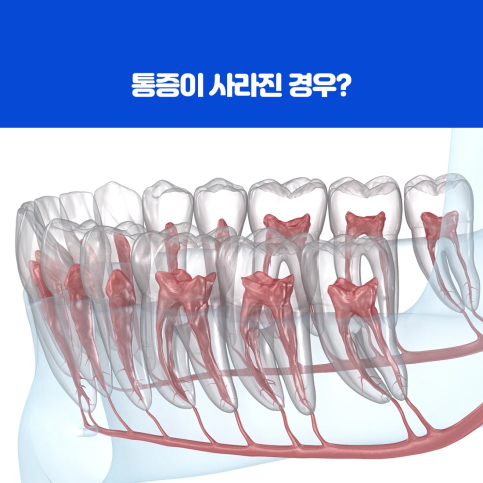 특수한 재료로 치아 내부 공간을 밀봉해 감염 재발을 막는 과정