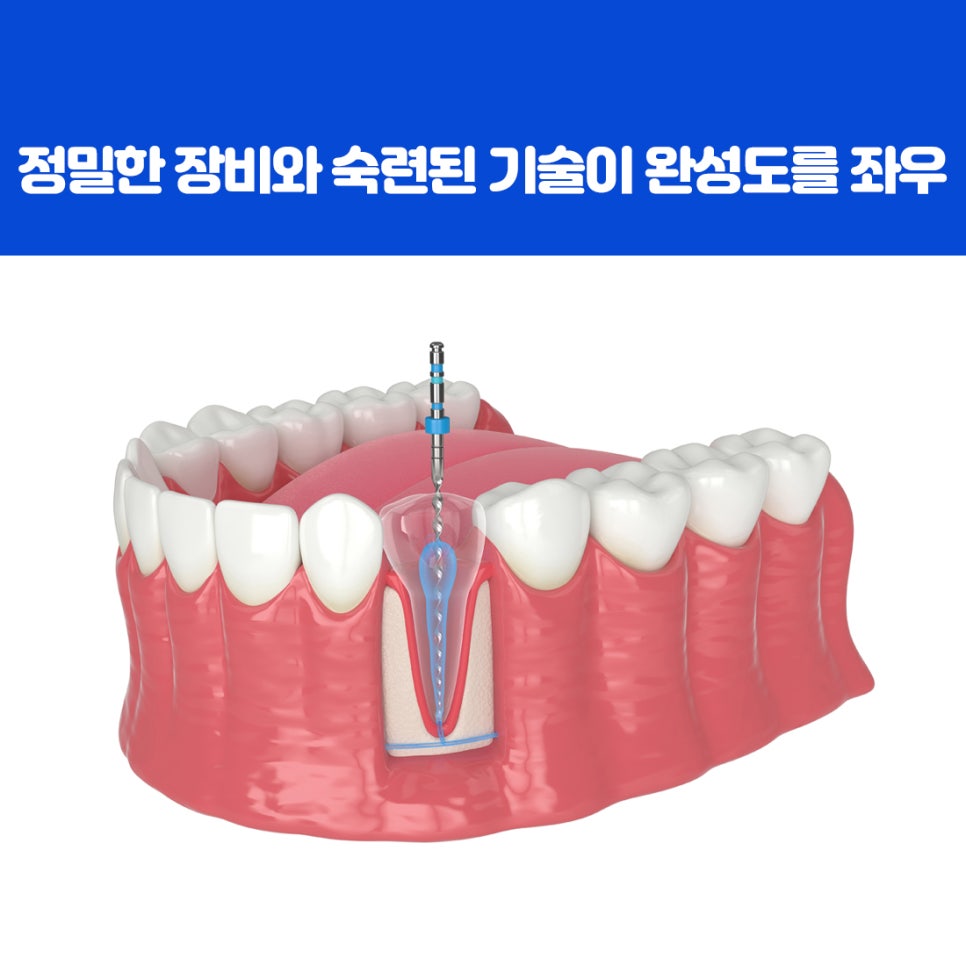 감염이 진행되어 치근 끝 부위에 염증이 생긴 치아와 치조골