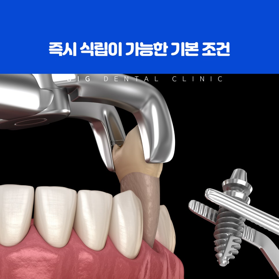 발치 후 잇몸뼈가 회복될 때까지 기다린 뒤 식립하는 일반 임플란트 치료