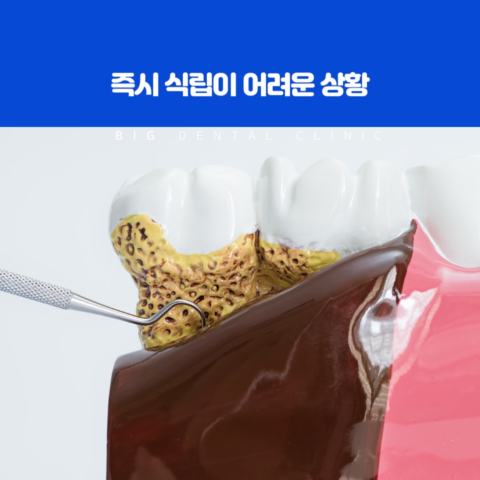 치아가 빠진 기간을 줄이고 잇몸뼈 흡수 감소에 도움이 되는 즉시 식립