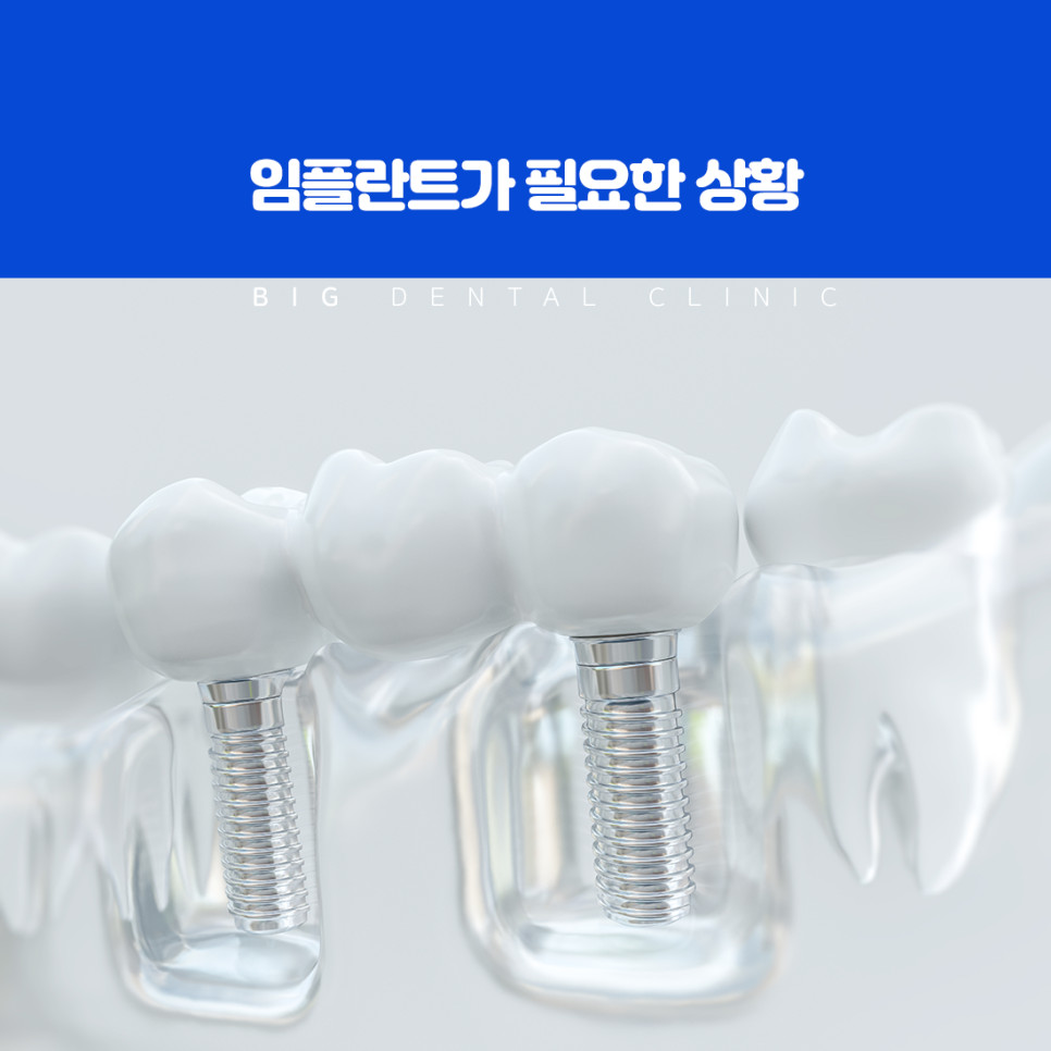 잇몸 뼈에 인공 치근을 심고 인공 치아를 올려 기능을 되살리는 임플란트 원리