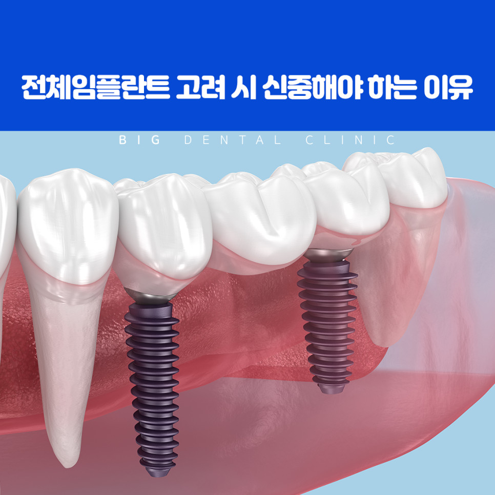 외상과 충치, 잇몸 질환, 보철물 노후로 임플란트를 고려하는 여러 상황