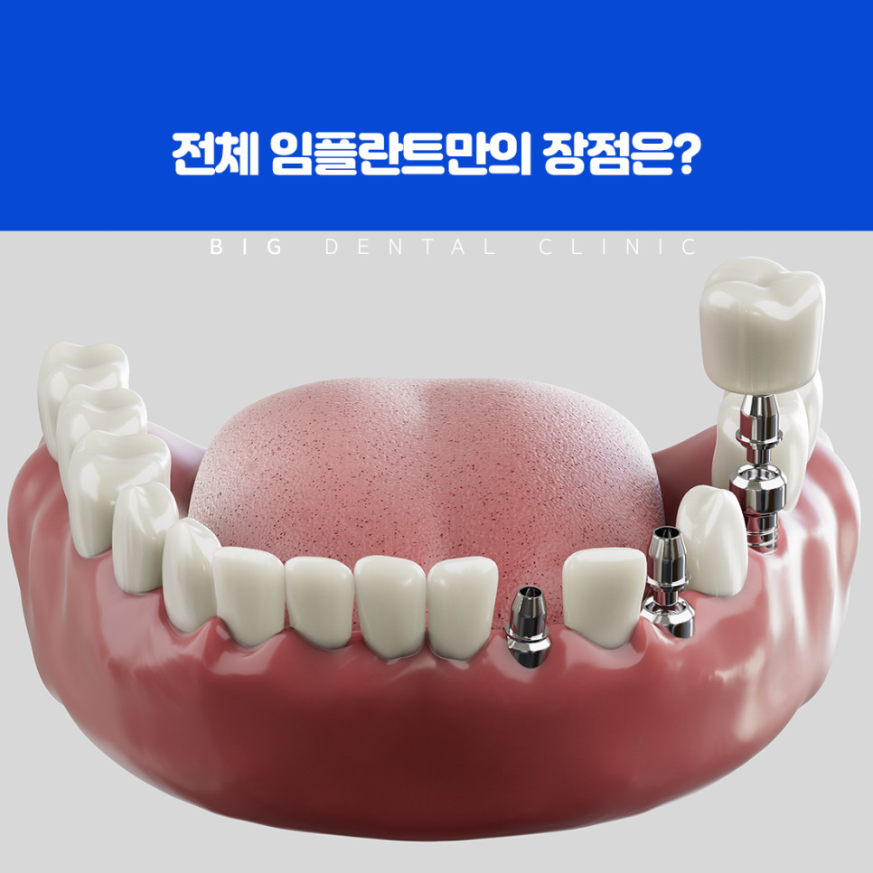 치아가 없는 상태를 오래 두면 잇몸 뼈가 약해지고 주변 치아가 틀어지는 변화