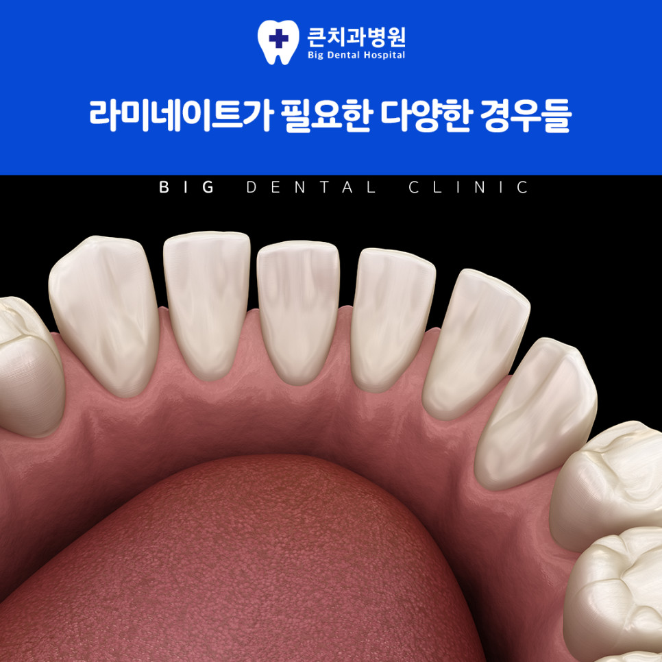 외형 고민이 작은 범위일 때 라미네이트를 고려하는 상황