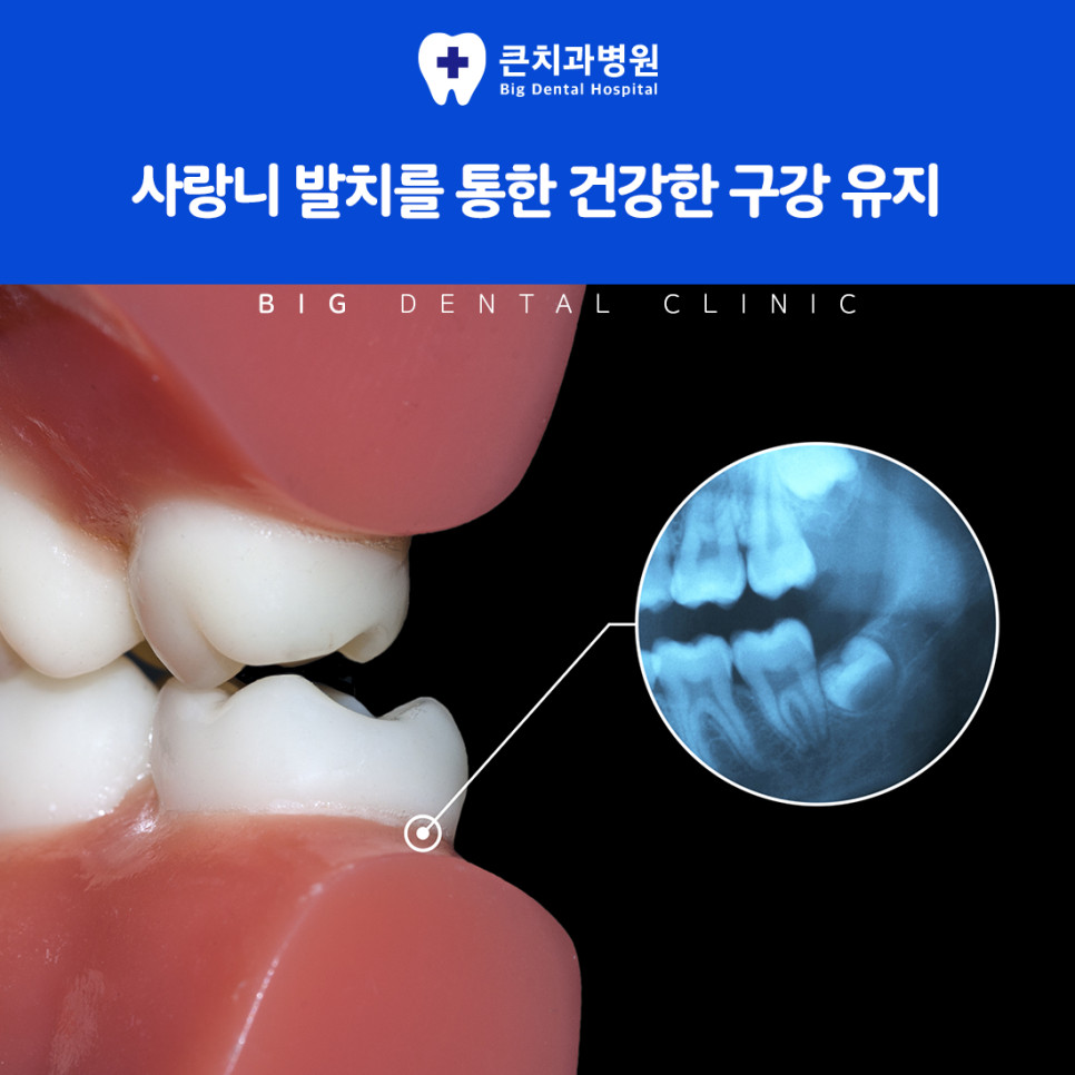 파노라마와 CT로 사랑니 위치를 분석해 세우는 발치 계획