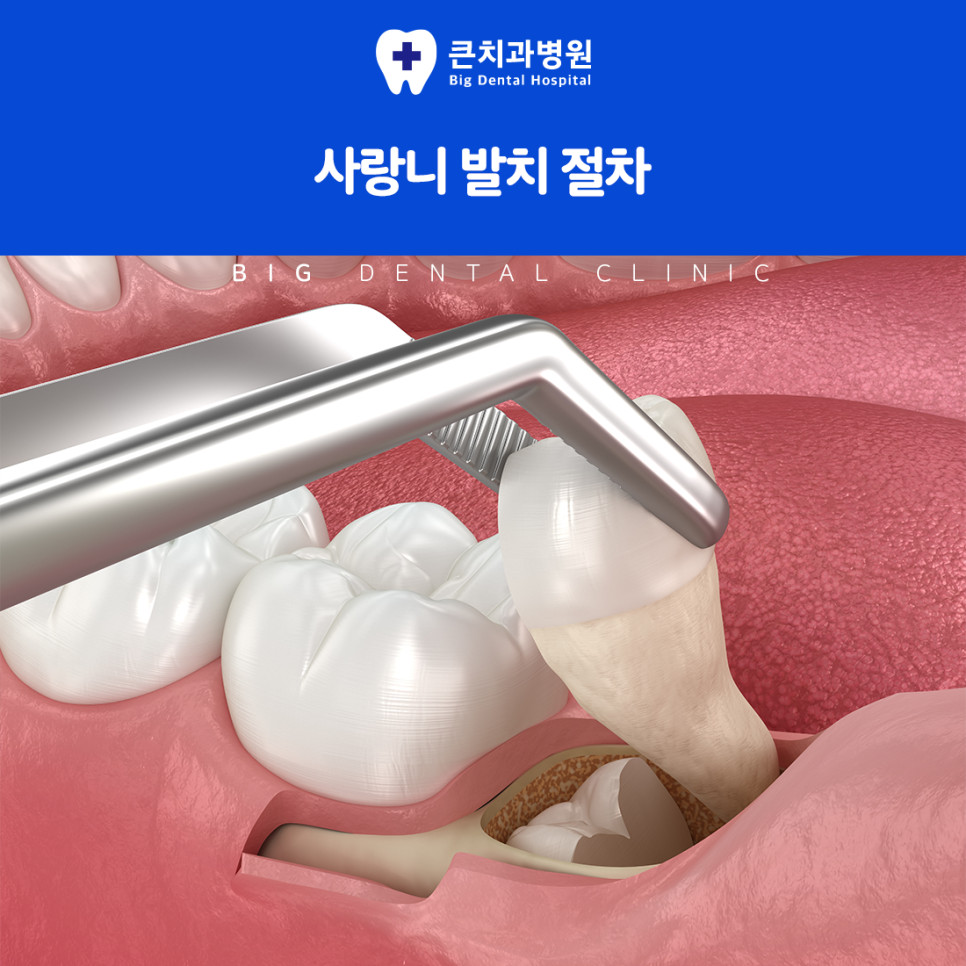 방치한 사랑니에서 늦게 발견되는 충치와 주변 치아 손상