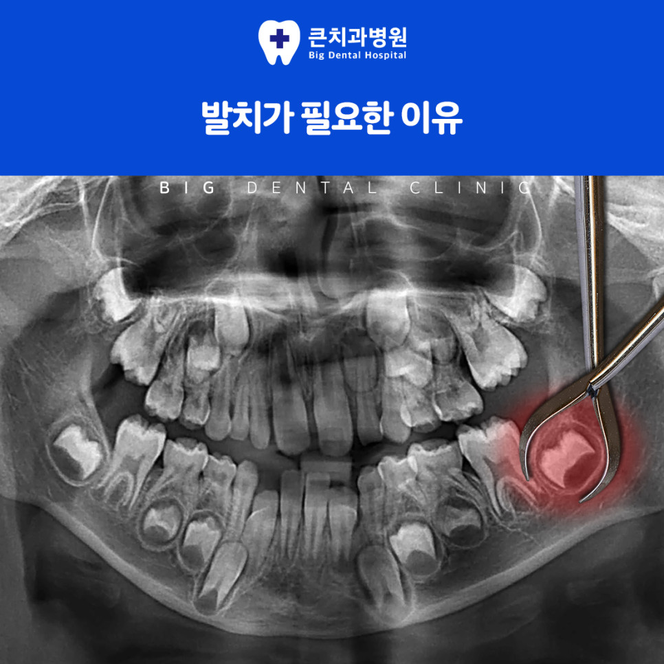 턱뼈 속에 묻혀 정상적으로 나오지 못한 매복 사랑니