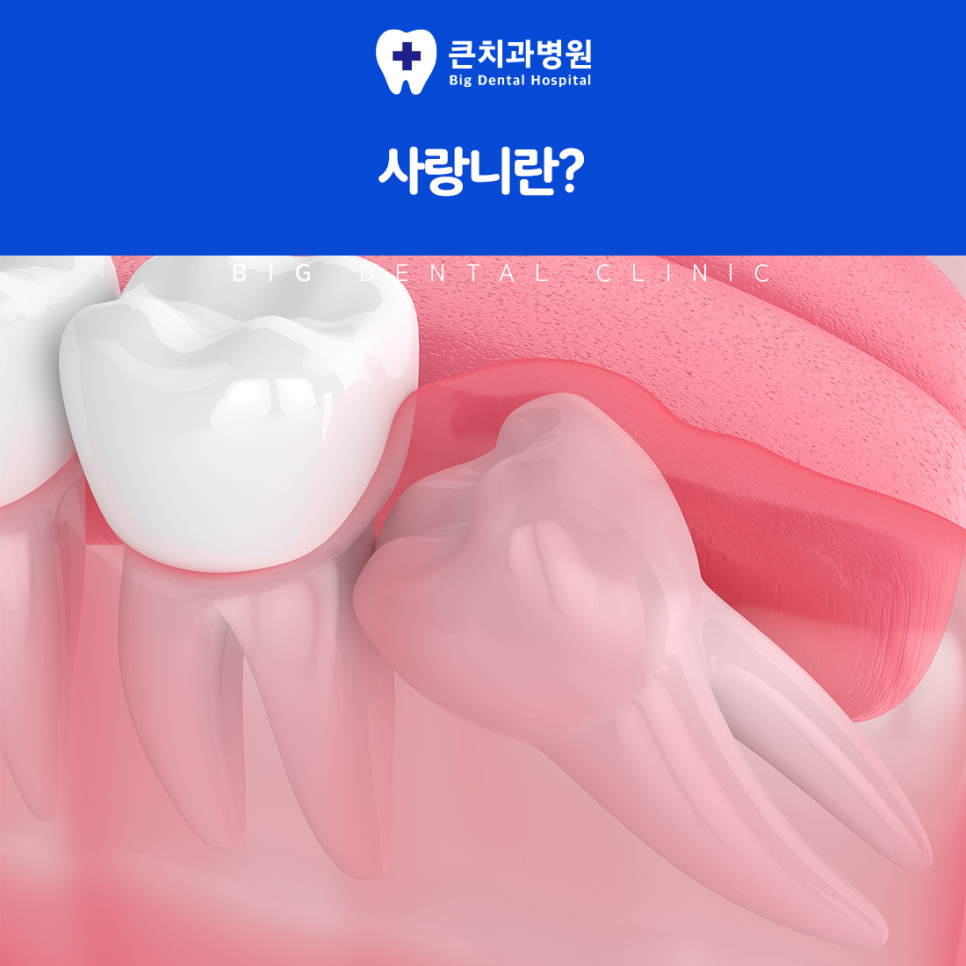 칫솔이 닿기 어려운 입안 가장 끝의 사랑니 위치