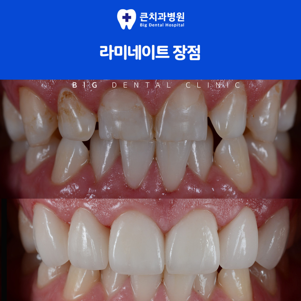치아 사이가 벌어지거나 살짝 어긋난 앞니의 개선 방향