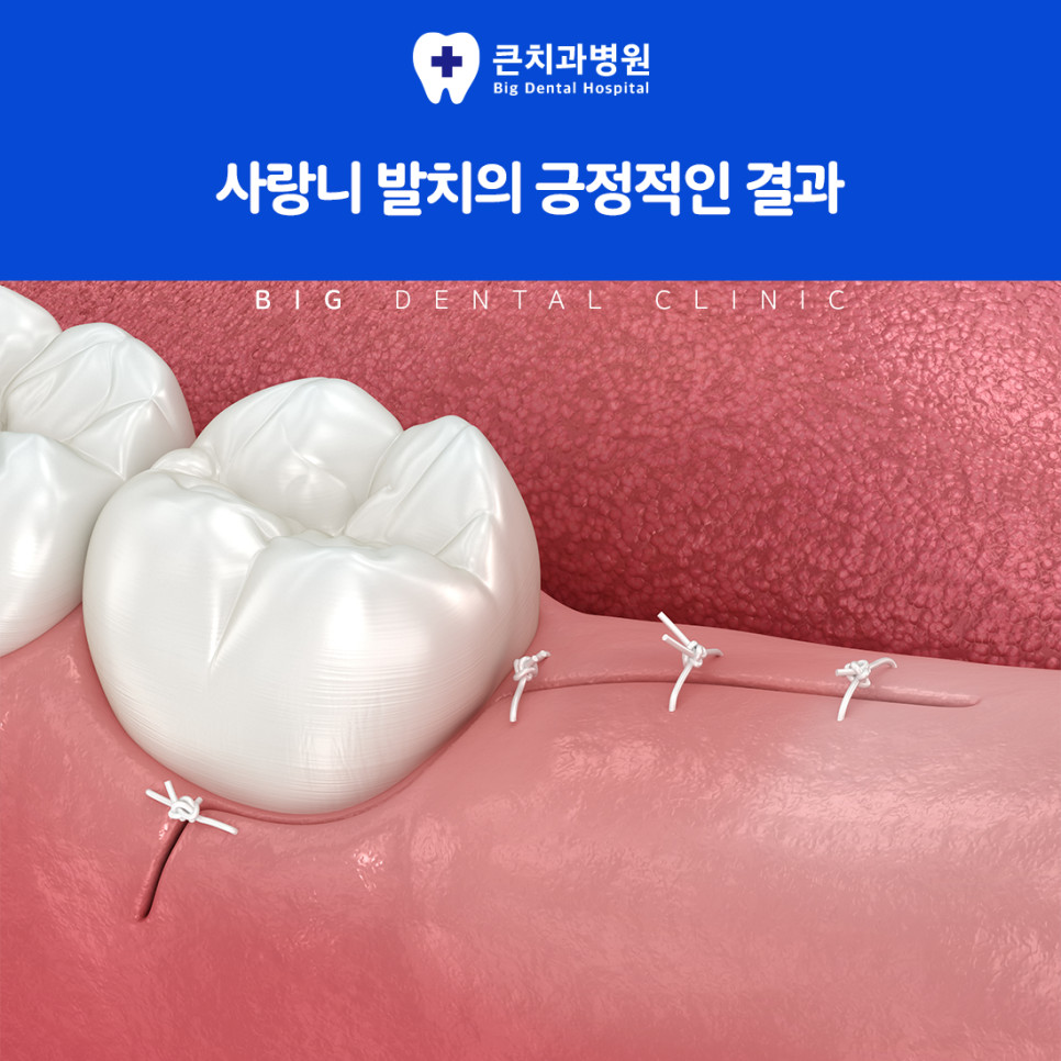 잇몸에 일부만 덮인 사랑니 주변에 반복되는 염증