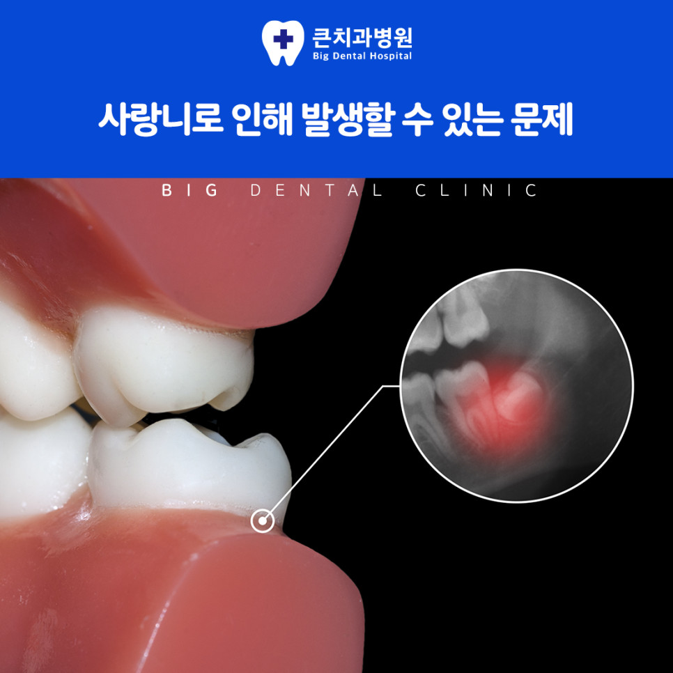 비스듬히 자란 사랑니에 밀려 손상되는 앞 어금니